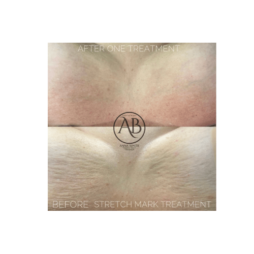 Stretch Mark Rejuvenation